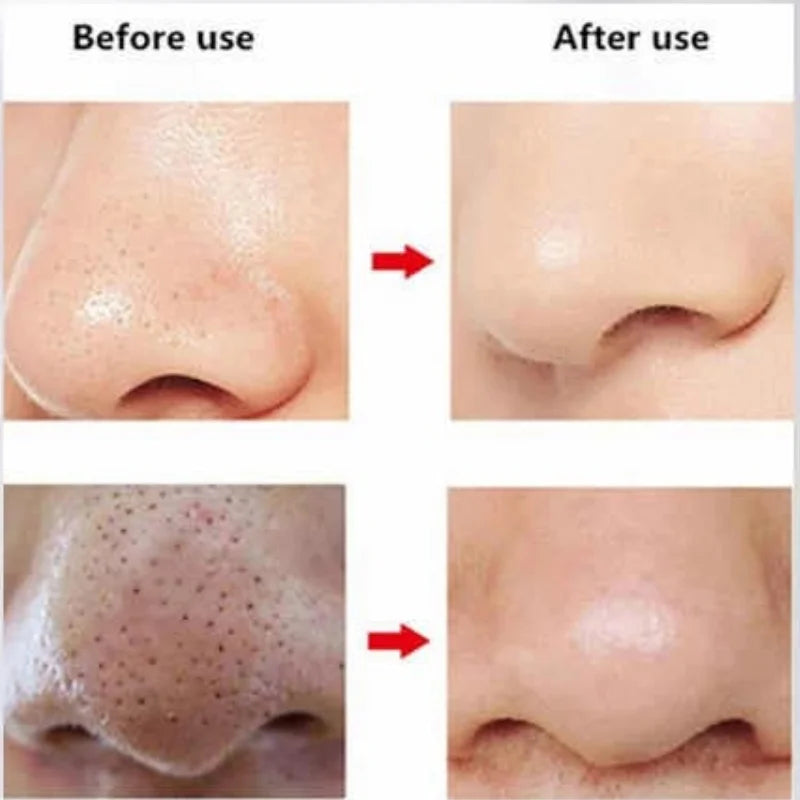 Rechargeable Blackhead Remover Vacuum Cleaner