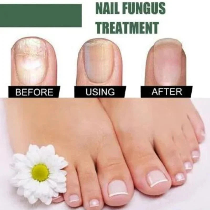 Fast Nail Fungus Treatment Serum