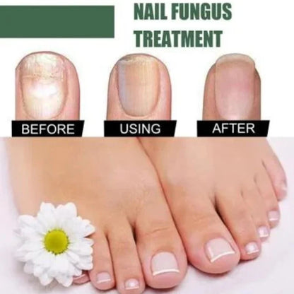 Fast Nail Fungus Treatment Serum